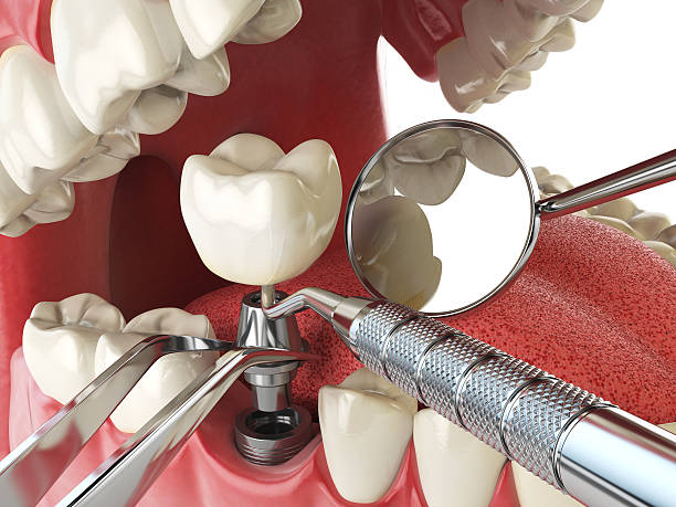 Best Dentist for Tooth Abscess  in Crystal City, MO